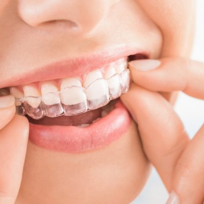 Woman wearing orthodontic silicone trainer. Invisible braces aligner. Mobile orthodontic appliance for dental correction.