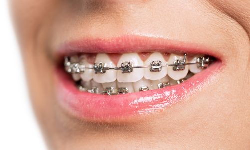 Teeth with braces isolated on white